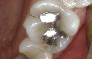 Old filling and cracked tooth